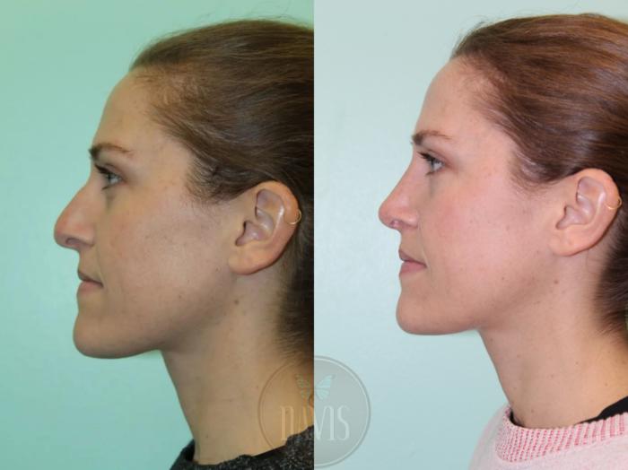 Before & After Female Rhinoplasty Case 1079 View 1 View in Tampa, FL