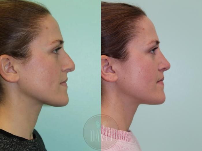 Before & After Female Rhinoplasty Case 1079 View 2 View in Tampa, FL