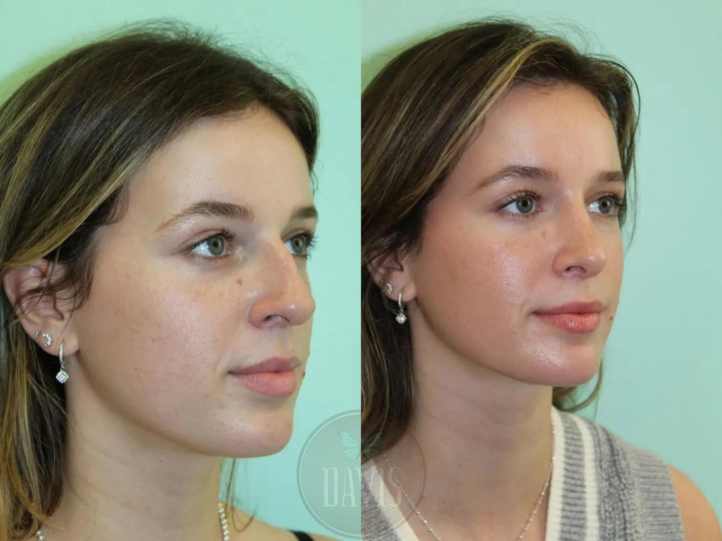 Female Rhinoplasty Before and After Pictures Case 1080 | Tampa, FL ...