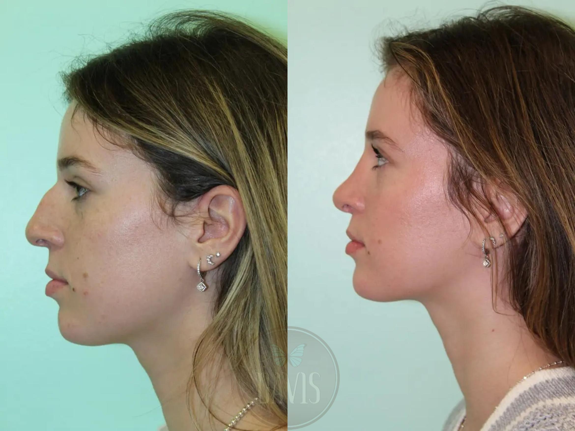Female Rhinoplasty Before and After Pictures Case 1080 | Tampa, FL ...