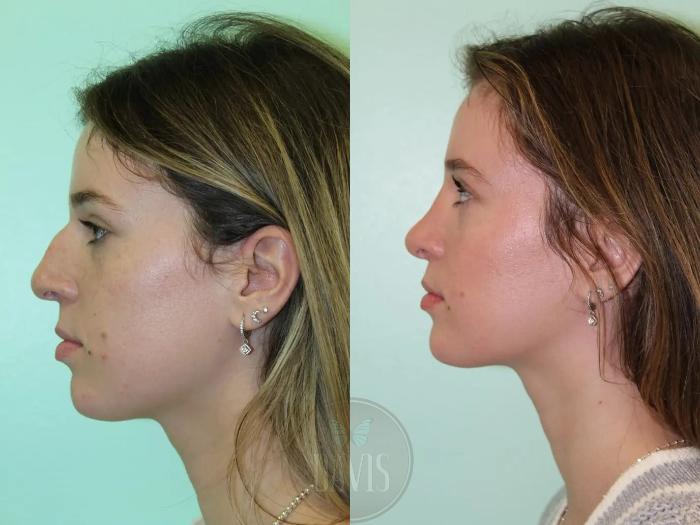 Before & After Female Rhinoplasty Case 1080 View 2 View in Tampa, FL