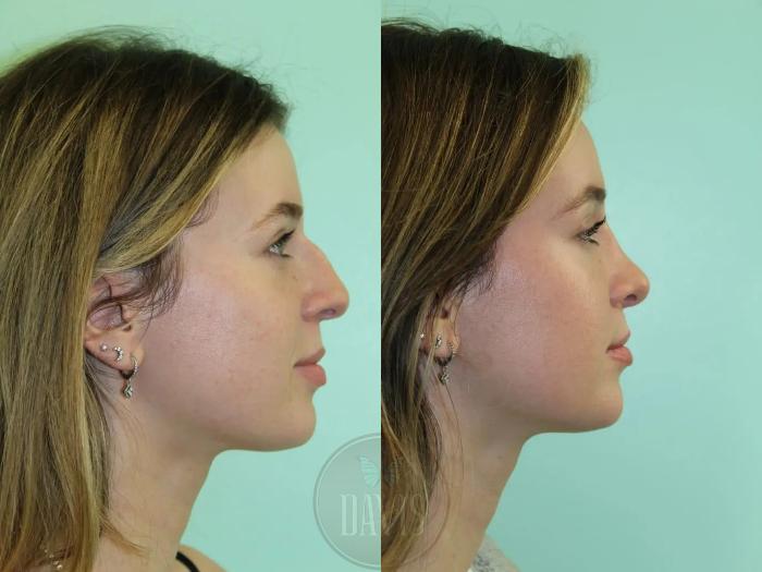 Before & After Female Rhinoplasty Case 1080 View 3 View in Tampa, FL