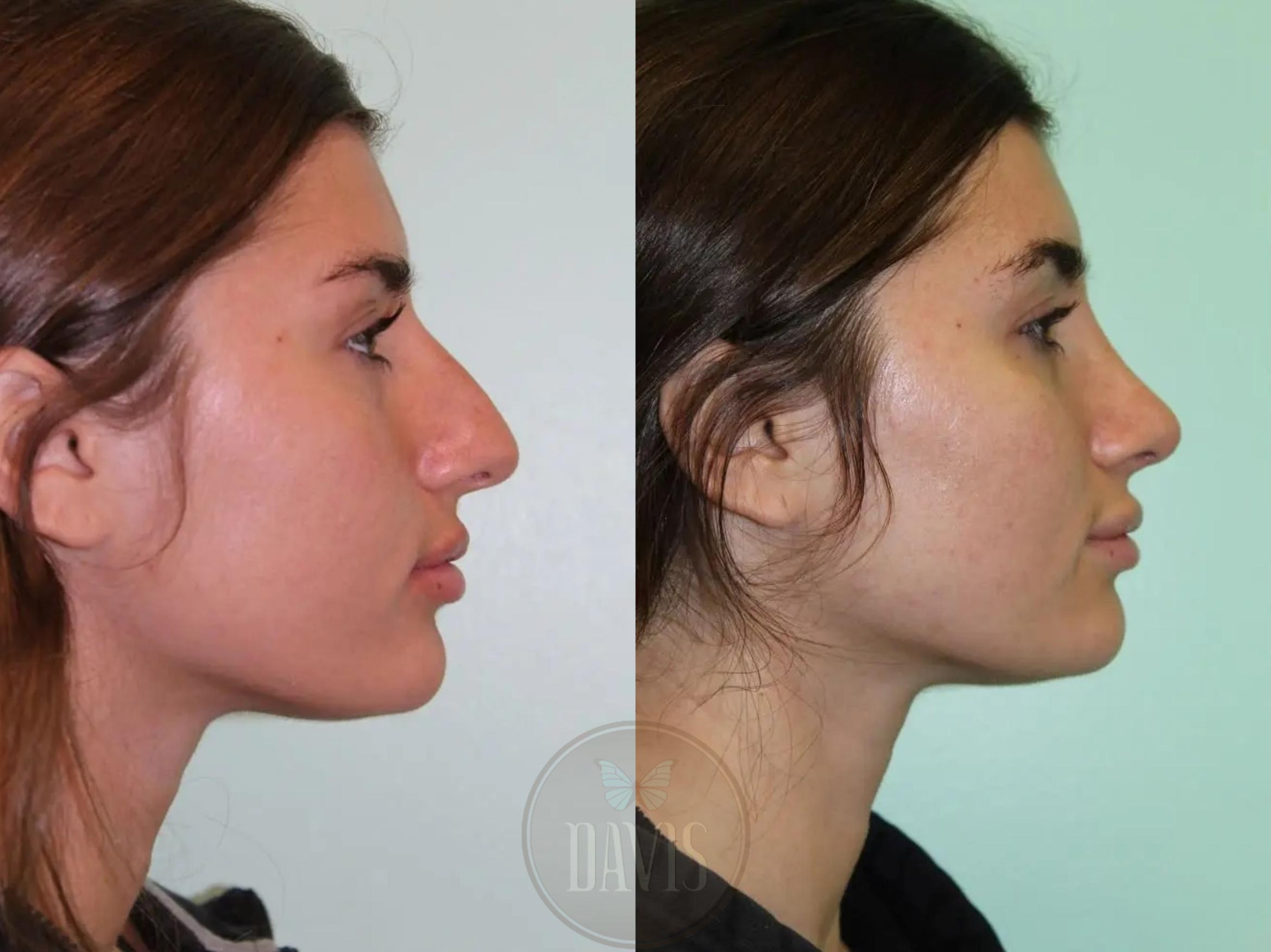 Before & After Female Rhinoplasty Case 1081 View 1 View in Tampa, FL