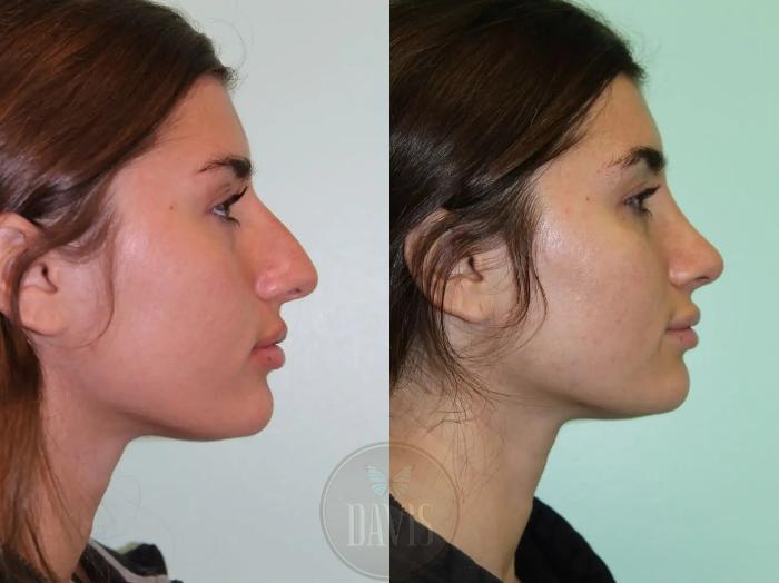 Before & After Female Rhinoplasty Case 1081 View 1 View in Tampa, FL