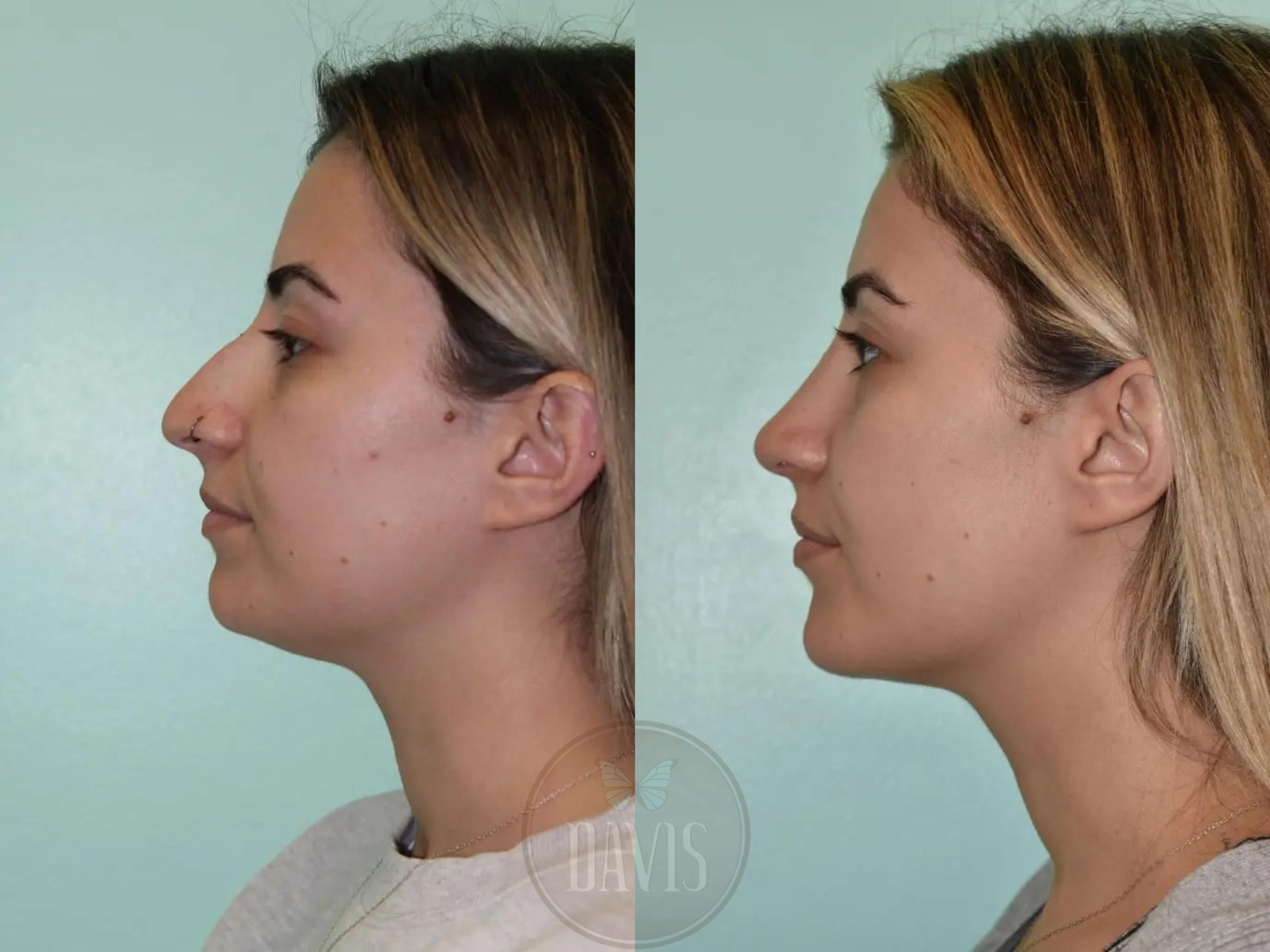 Before & After Female Rhinoplasty Case 1082 View 2 View in Tampa, FL