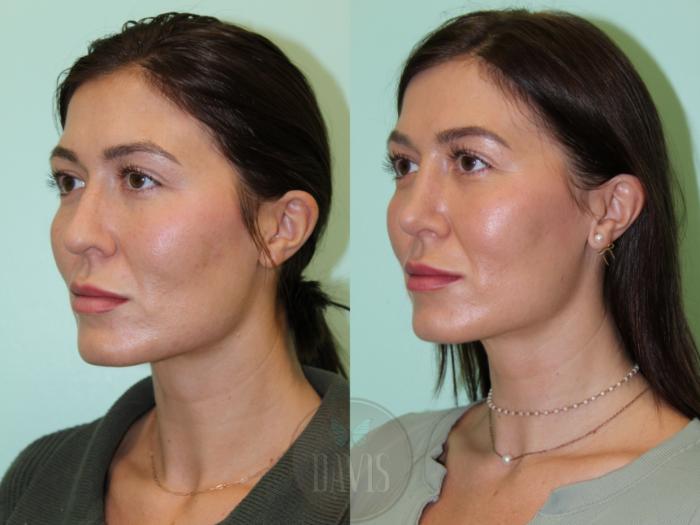 Before & After Female Rhinoplasty Case 1083 Left Side View in Tampa, FL