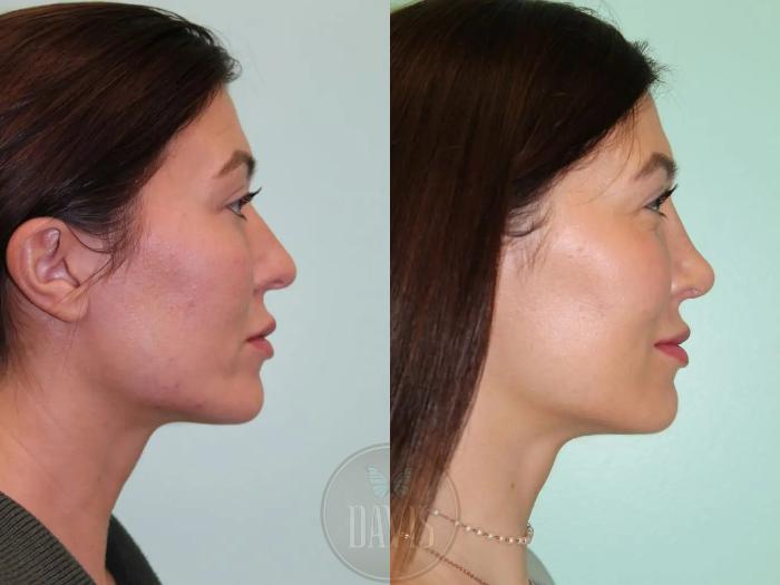 Before & After Female Rhinoplasty Case 1083 View 1 View in Tampa, FL