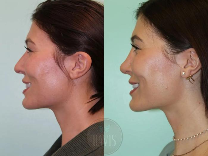 Before & After Female Rhinoplasty Case 1083 View 2 View in Tampa, FL