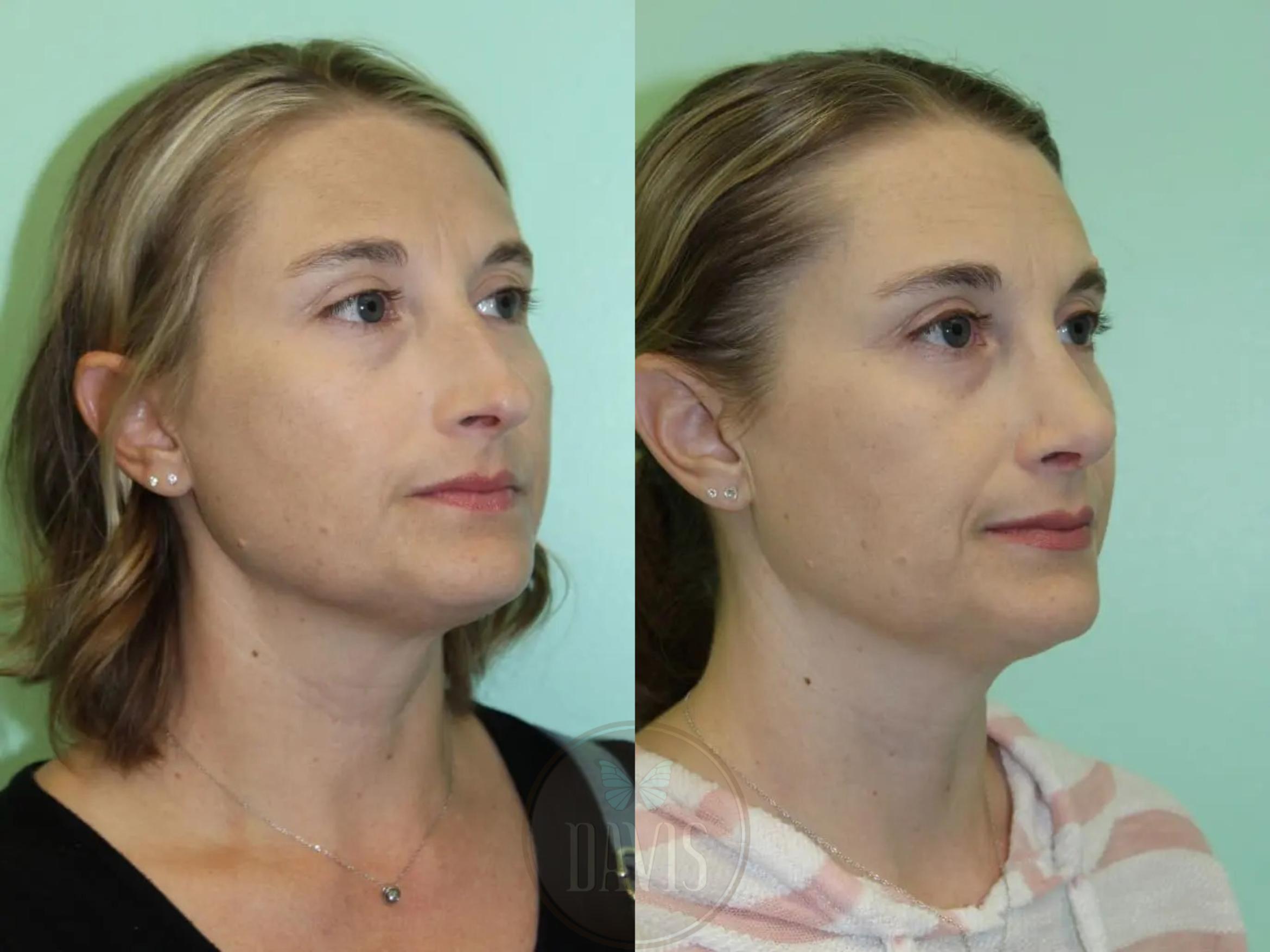 Before & After Female Rhinoplasty Case 1084 View 1 View in Tampa, FL
