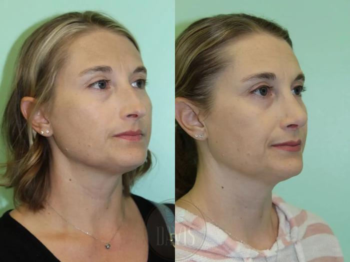Before & After Female Rhinoplasty Case 1084 View 1 View in Tampa, FL