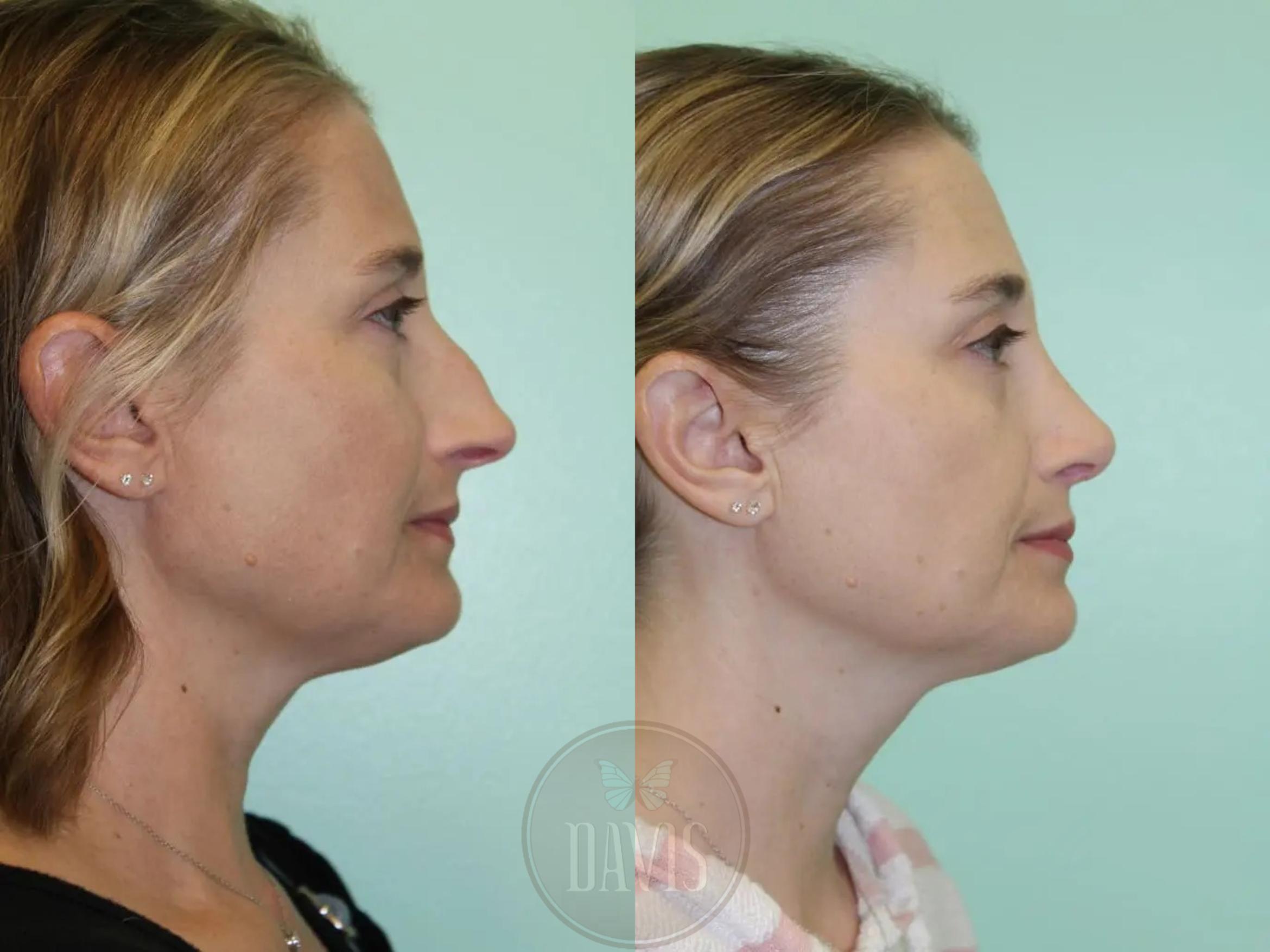 Before & After Female Rhinoplasty Case 1084 View 2 View in Tampa, FL