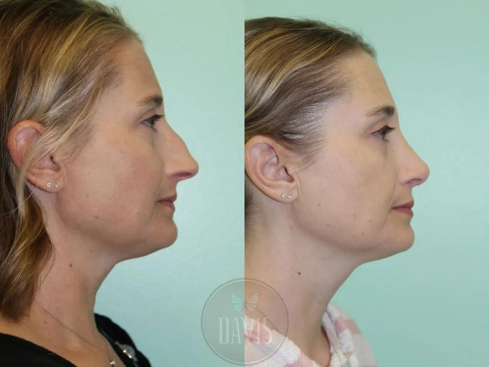 Before & After Female Rhinoplasty Case 1084 View 2 View in Tampa, FL