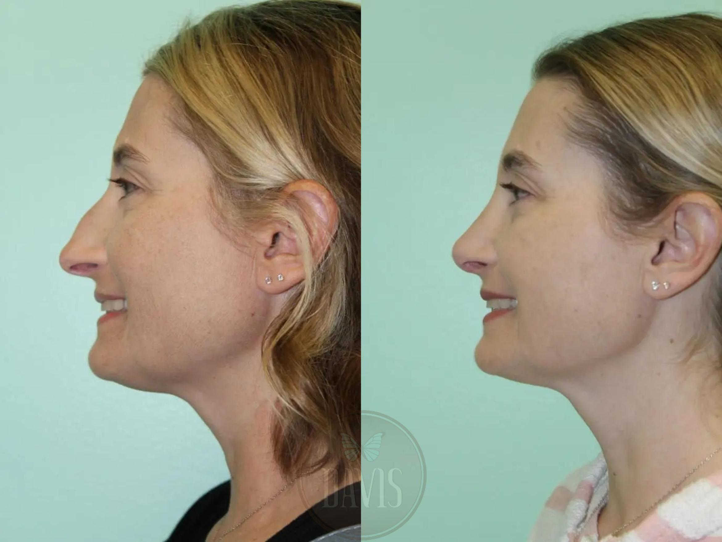 Before & After Female Rhinoplasty Case 1084 View 3 View in Tampa, FL