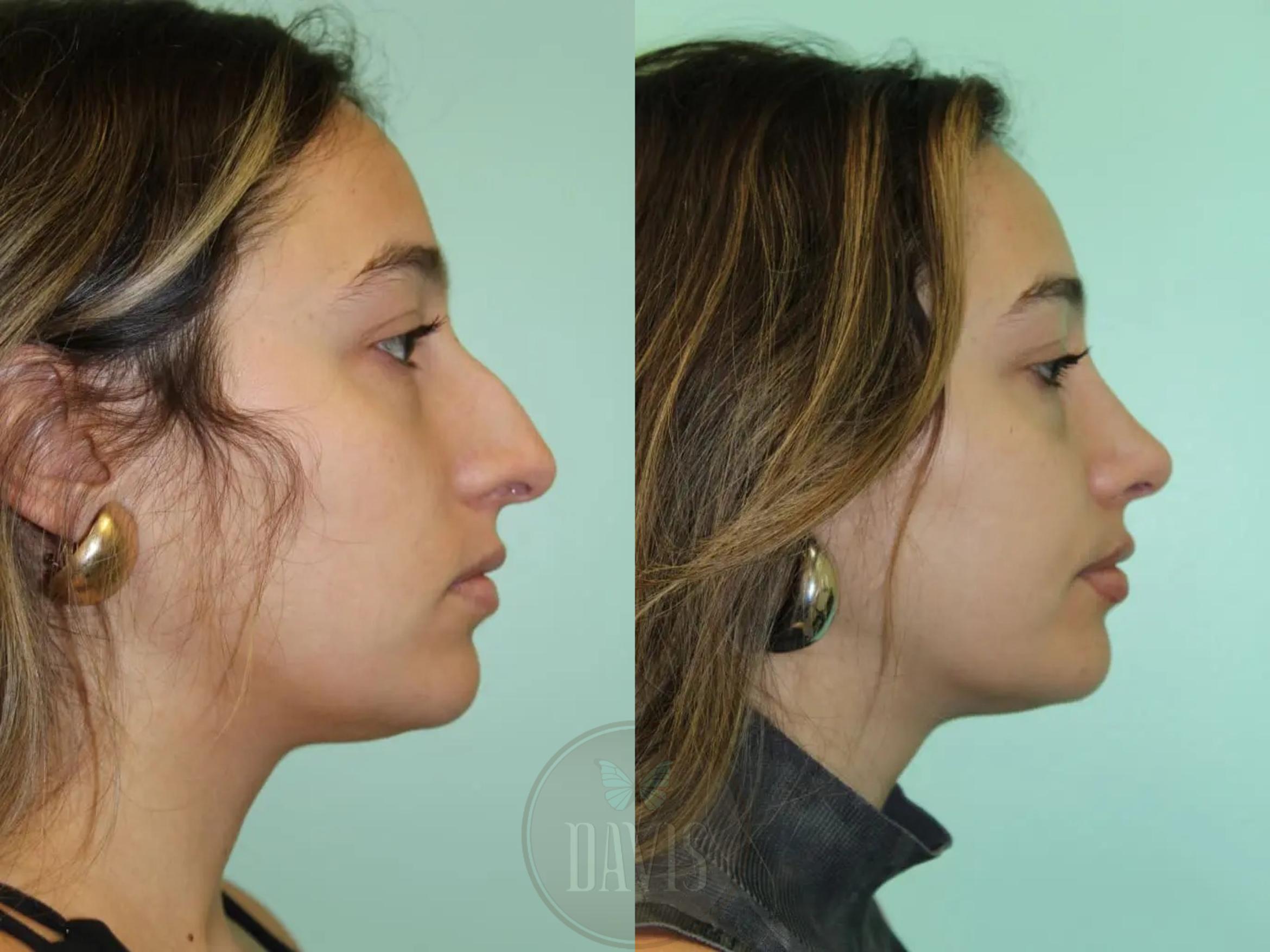 Before & After Female Rhinoplasty Case 1085 View 1 View in Tampa, FL