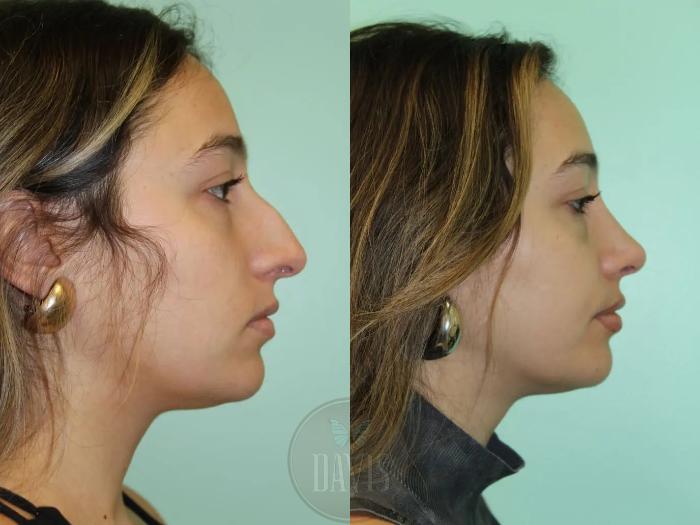 Before & After Female Rhinoplasty Case 1085 View 1 View in Tampa, FL