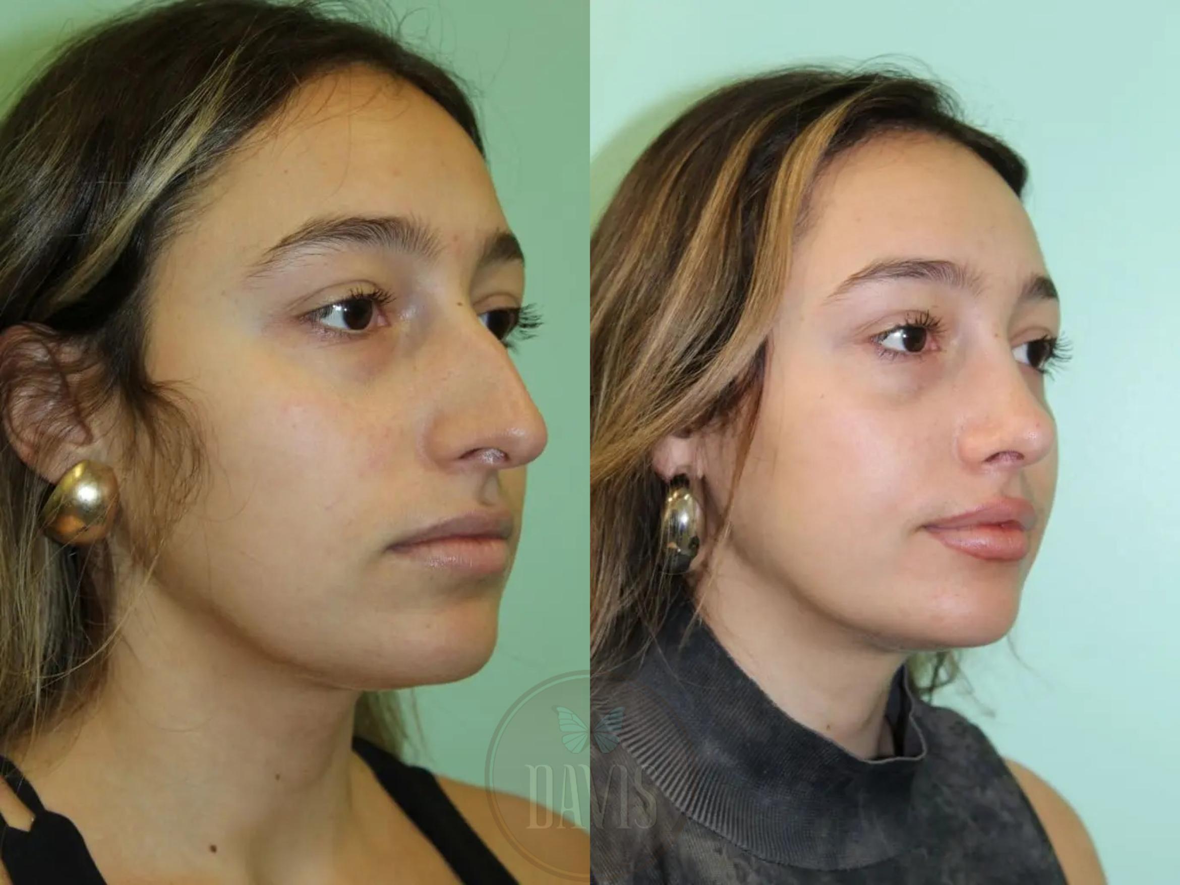 Before & After Female Rhinoplasty Case 1085 View 2 View in Tampa, FL