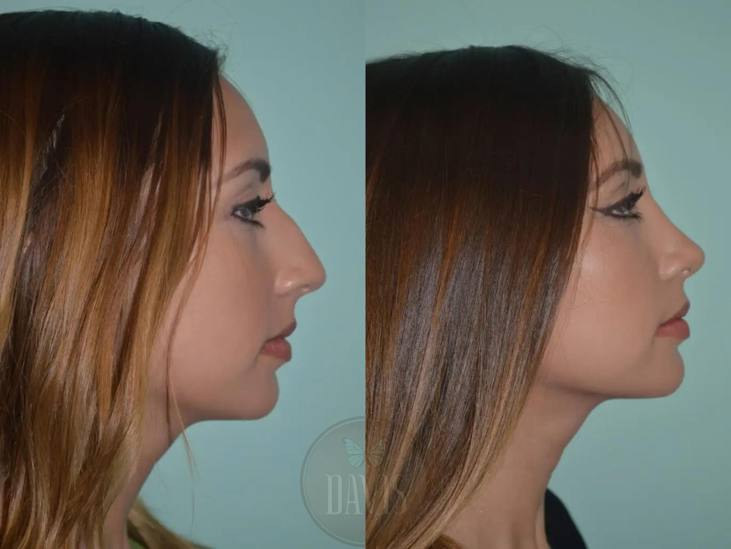 Before & After Female Rhinoplasty Case 1086 View 1 View in Tampa, FL