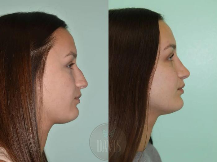 Before & After Female Rhinoplasty Case 1087 View 1 View in Tampa, FL