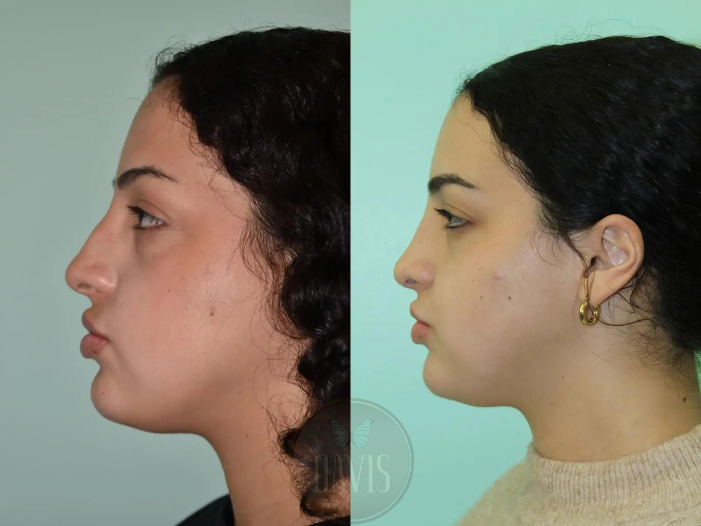 Before & After Female Rhinoplasty Case 1088 View 1 View in Tampa, FL