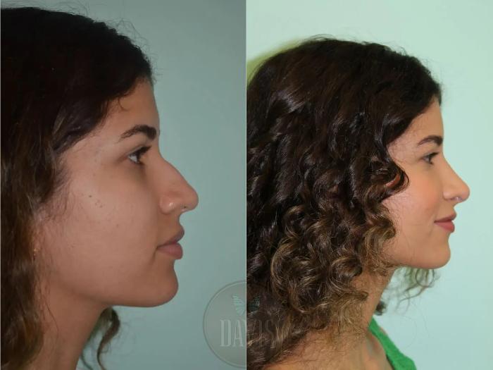 Before & After Female Rhinoplasty Case 1089 View 1 View in Tampa, FL