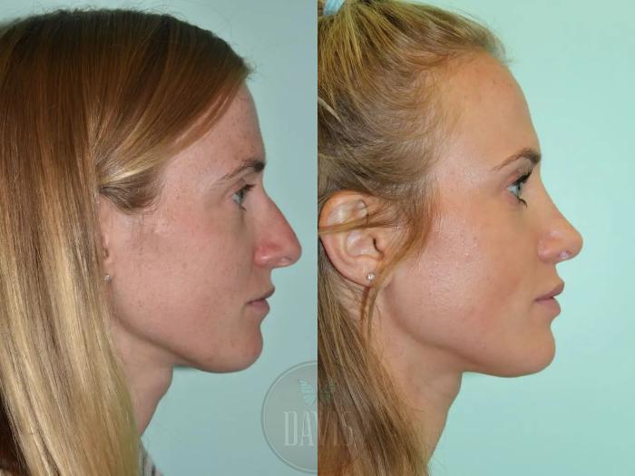 Before & After Female Rhinoplasty Case 1090 View 2 View in Tampa, FL