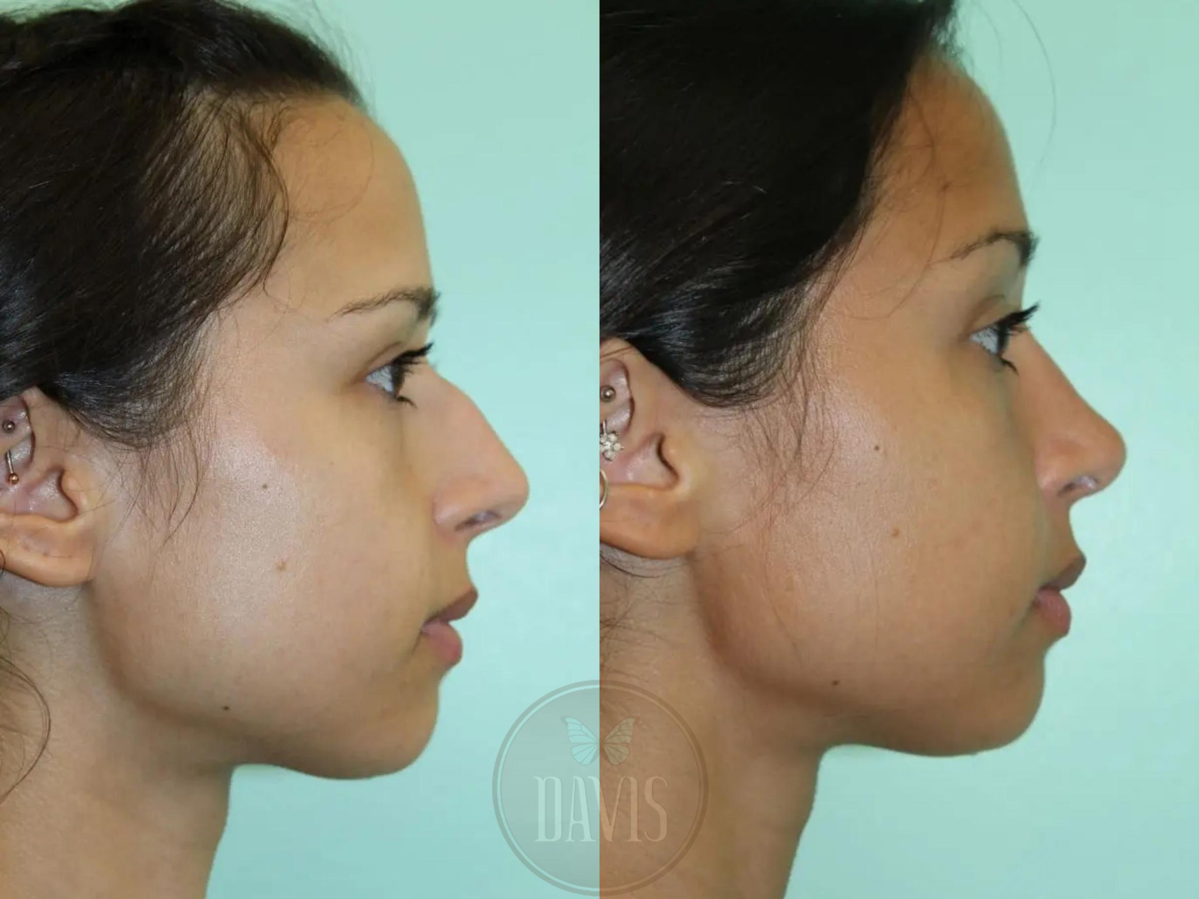Before & After Female Rhinoplasty Case 1091 View 1 View in Tampa, FL