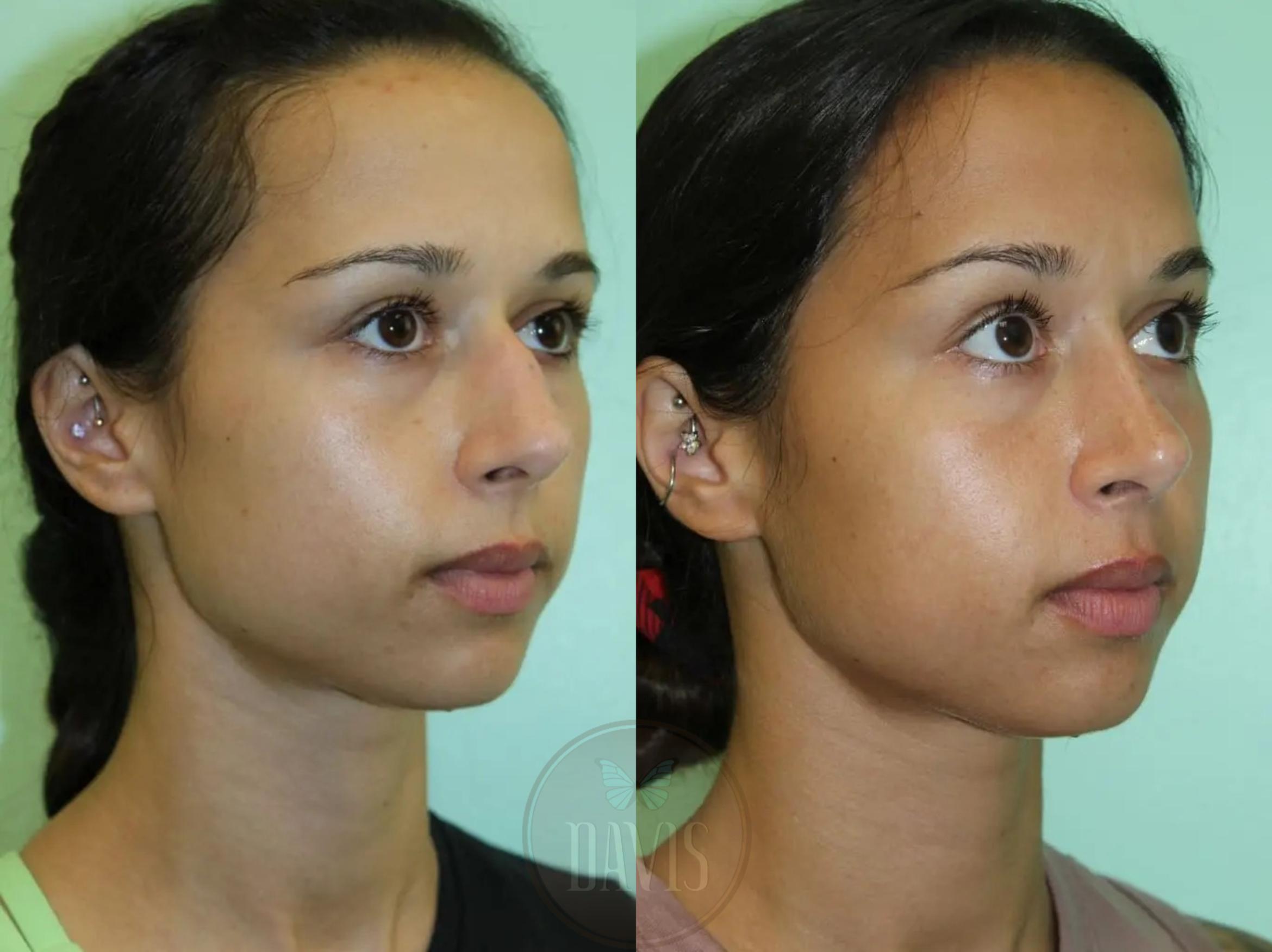 Before & After Female Rhinoplasty Case 1091 View 2 View in Tampa, FL