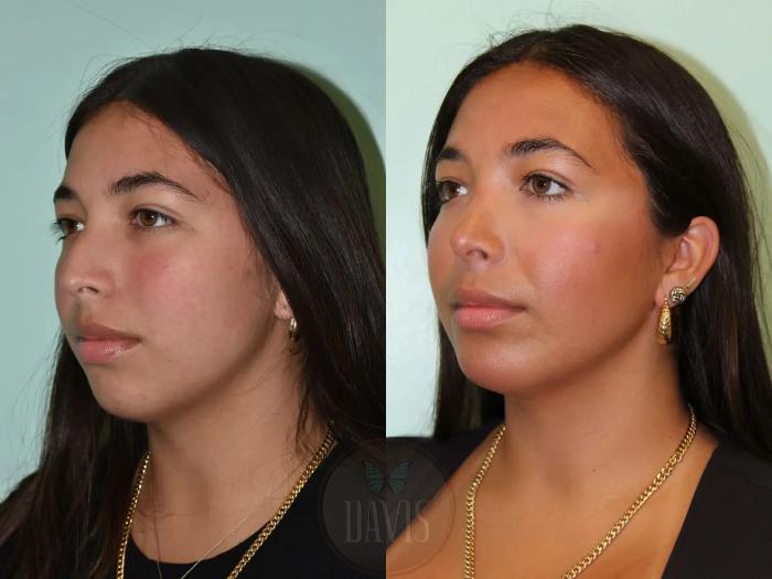 Before & After Female Rhinoplasty Case 1092 View 1 View in Tampa, FL