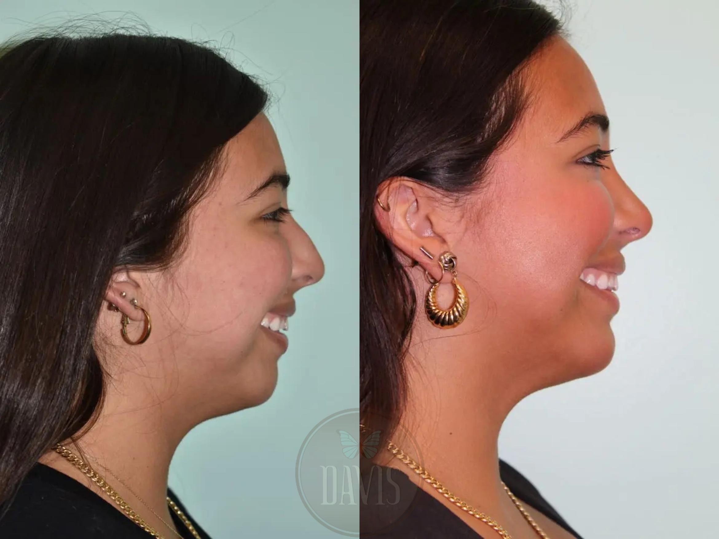 Before & After Female Rhinoplasty Case 1092 View 2 View in Tampa, FL