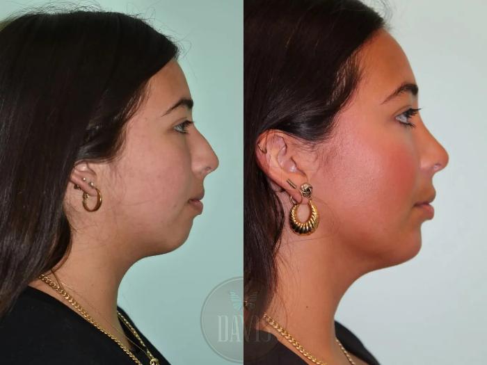 Before & After Female Rhinoplasty Case 1092 View 3 View in Tampa, FL