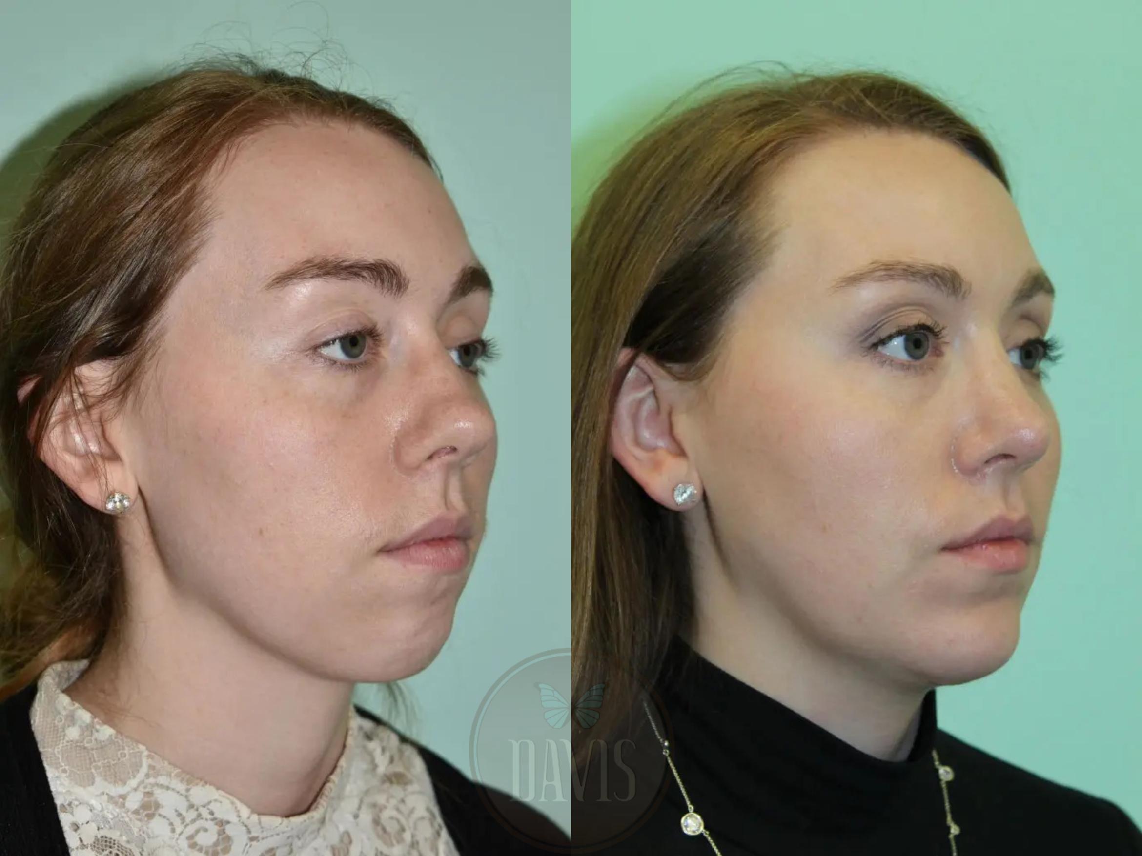 Before & After Female Rhinoplasty Case 1093 View 1 View in Tampa, FL