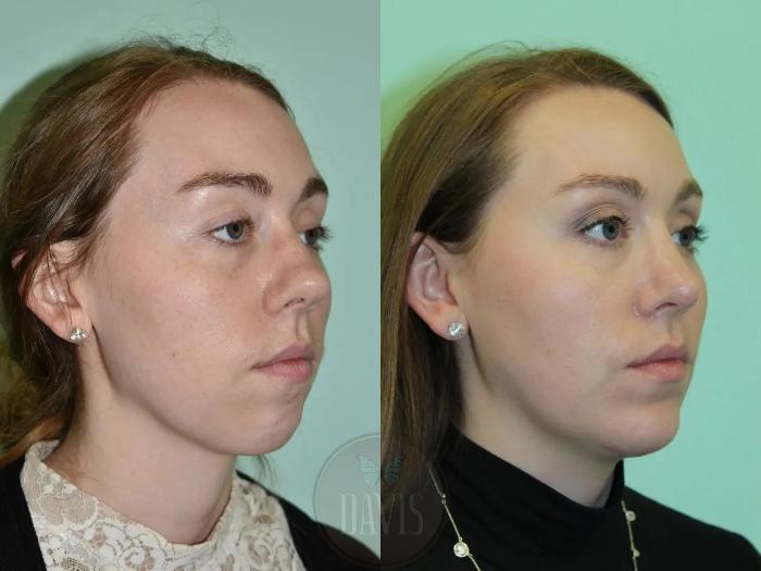 Before & After Female Rhinoplasty Case 1093 View 1 View in Tampa, FL