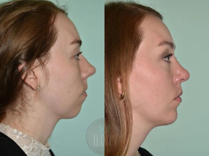 Before & After Female Rhinoplasty Case 1093 View 2 View in Tampa, FL