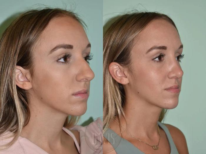 Before & After Female Rhinoplasty Case 1094 View 1 View in Tampa, FL