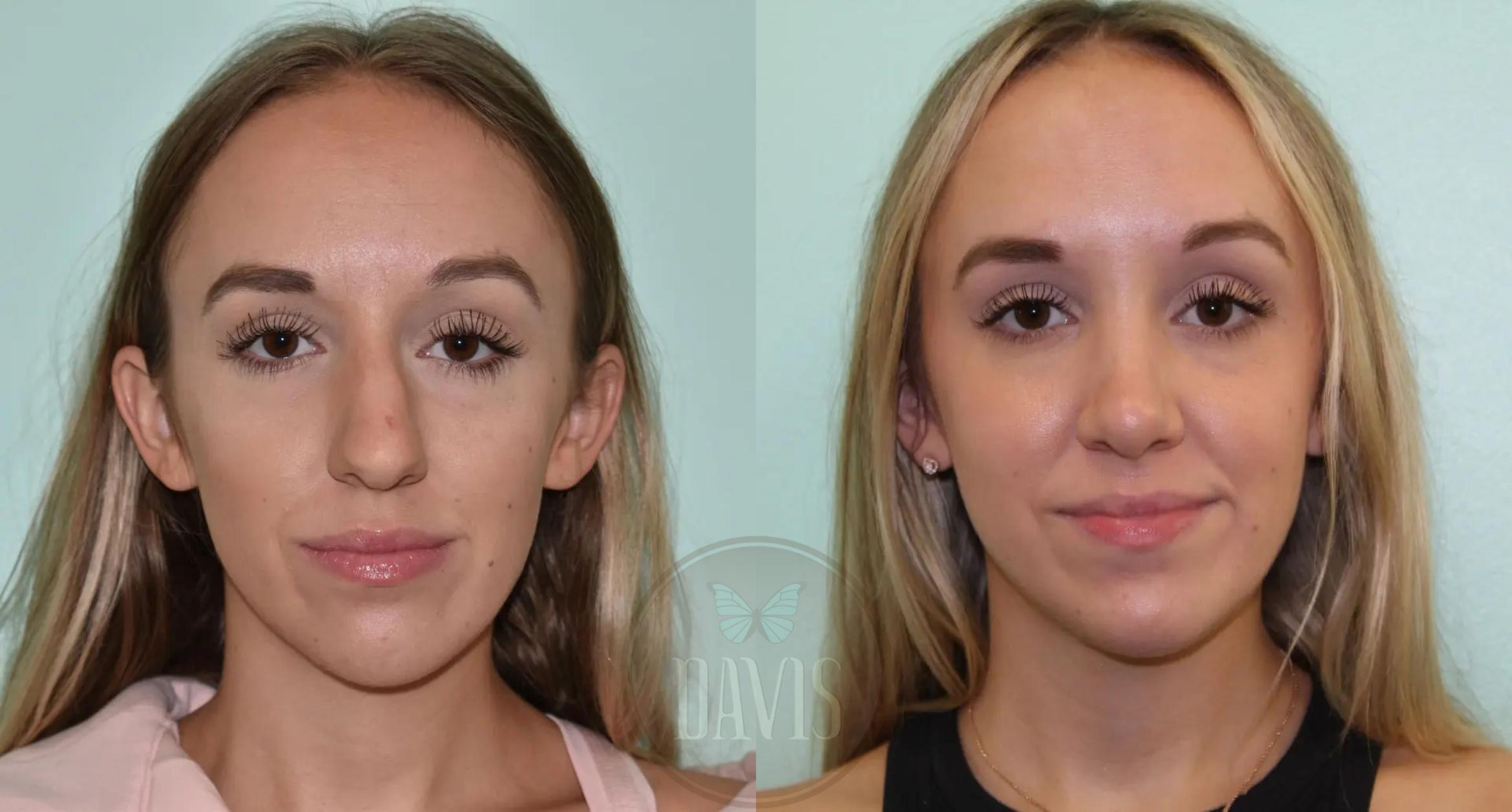 Before & After Female Rhinoplasty Case 1094 View 2 View in Tampa, FL