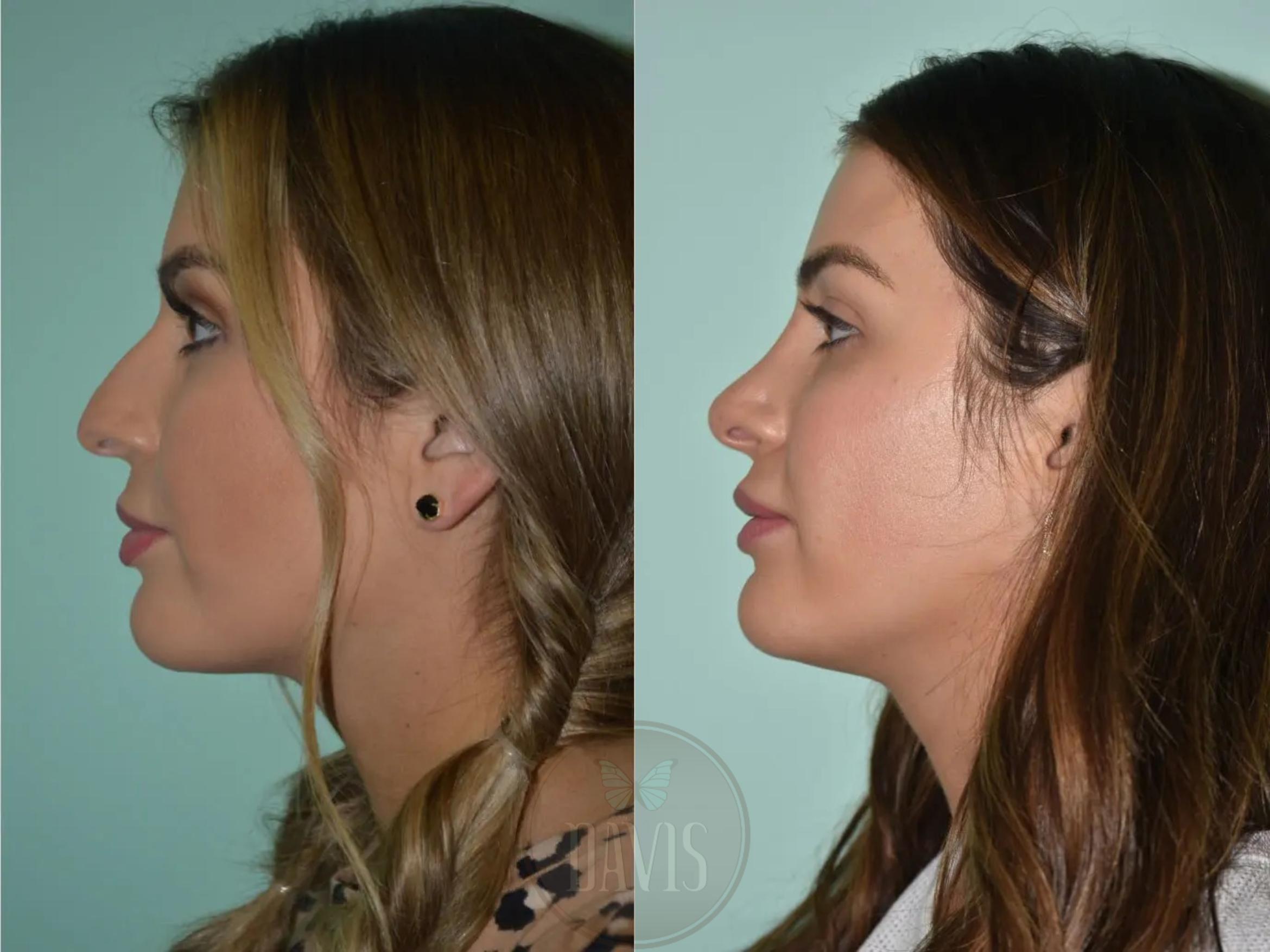 Before & After Female Rhinoplasty Case 1095 View 1 View in Tampa, FL