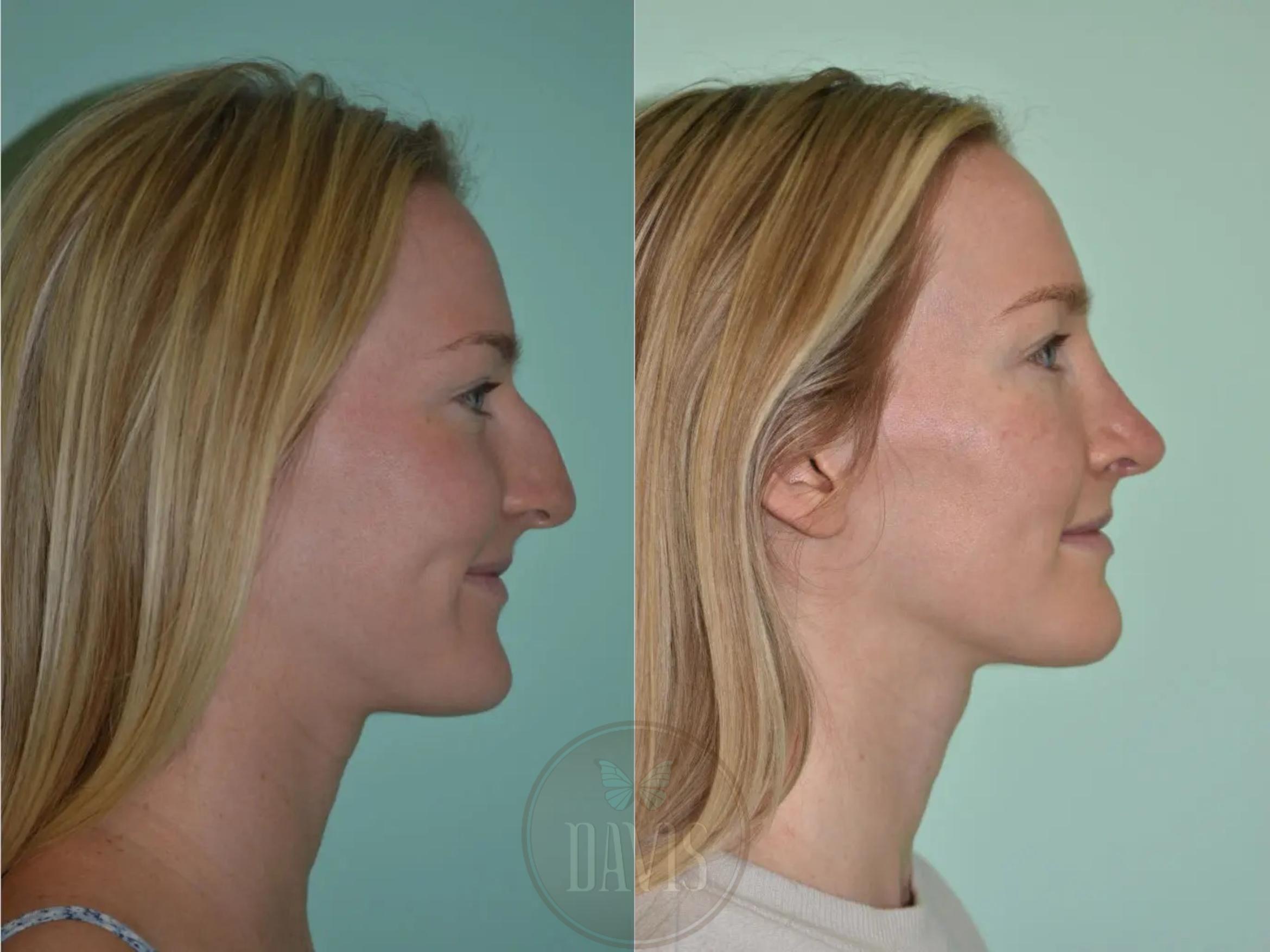 Before & After Female Rhinoplasty Case 1096 View 1 View in Tampa, FL