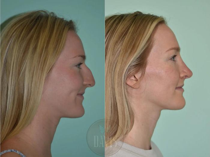 Before & After Female Rhinoplasty Case 1096 View 1 View in Tampa, FL