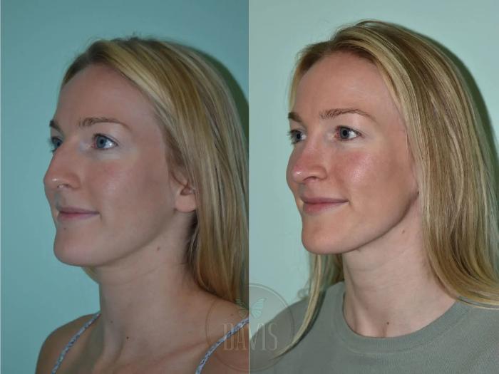 Before & After Female Rhinoplasty Case 1096 View 2 View in Tampa, FL