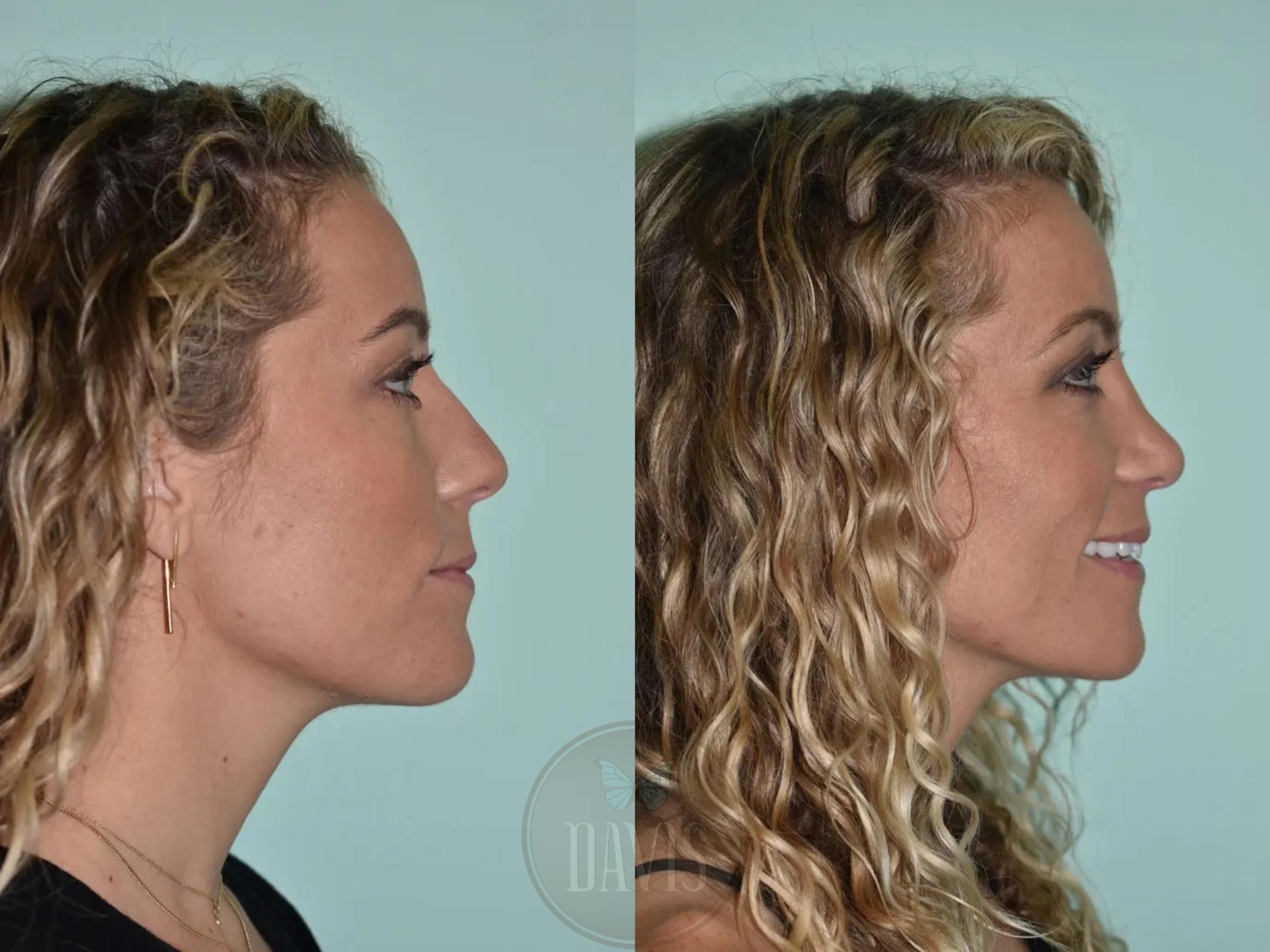 Female Rhinoplasty Before and After Pictures Case 1097 | Tampa, FL ...