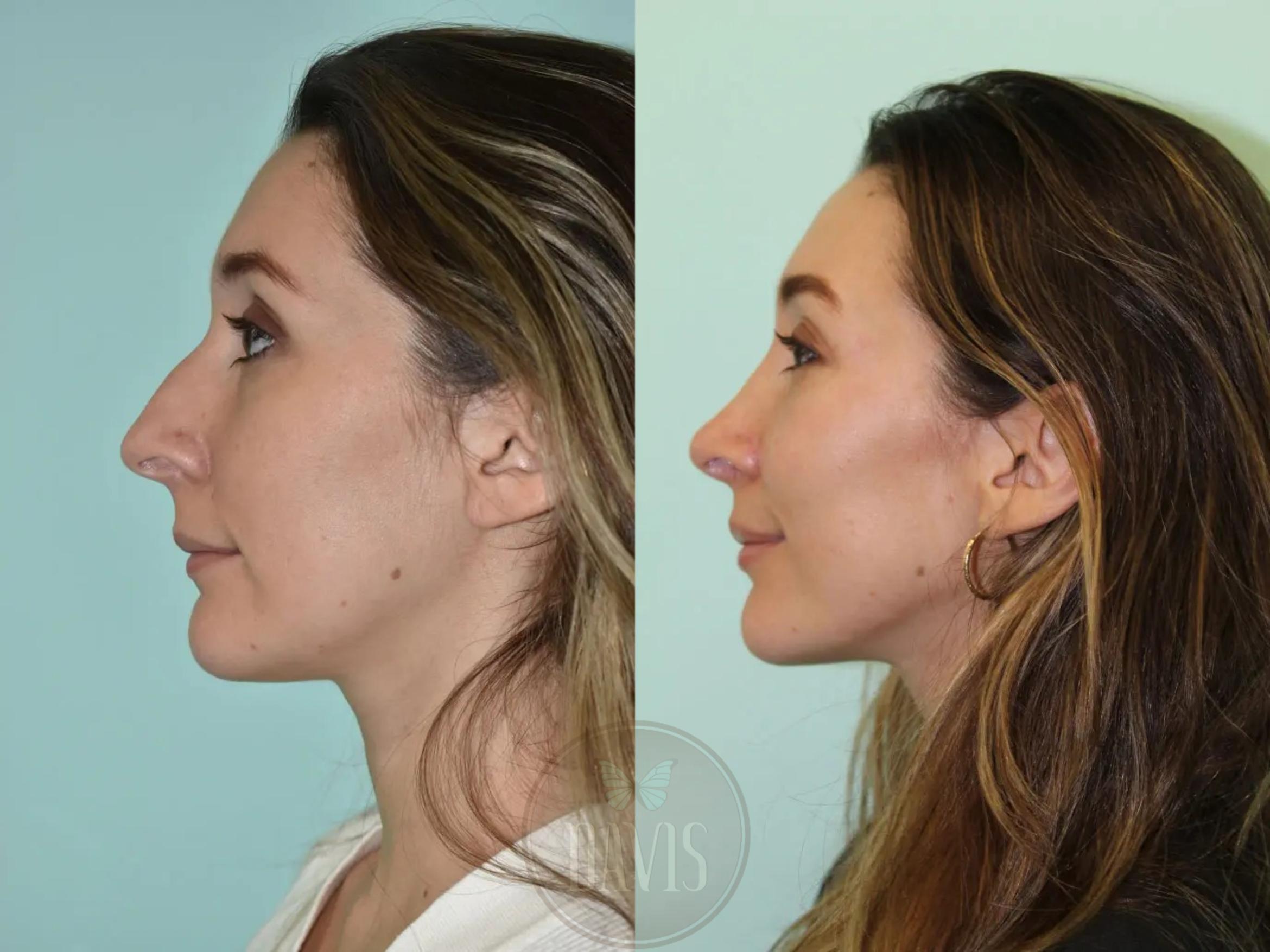 Female Rhinoplasty in Tampa, FL - Davis Facial Plastic Surgery