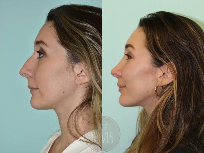 Before & After Female Rhinoplasty Case 1098 View 1 View in Tampa, FL