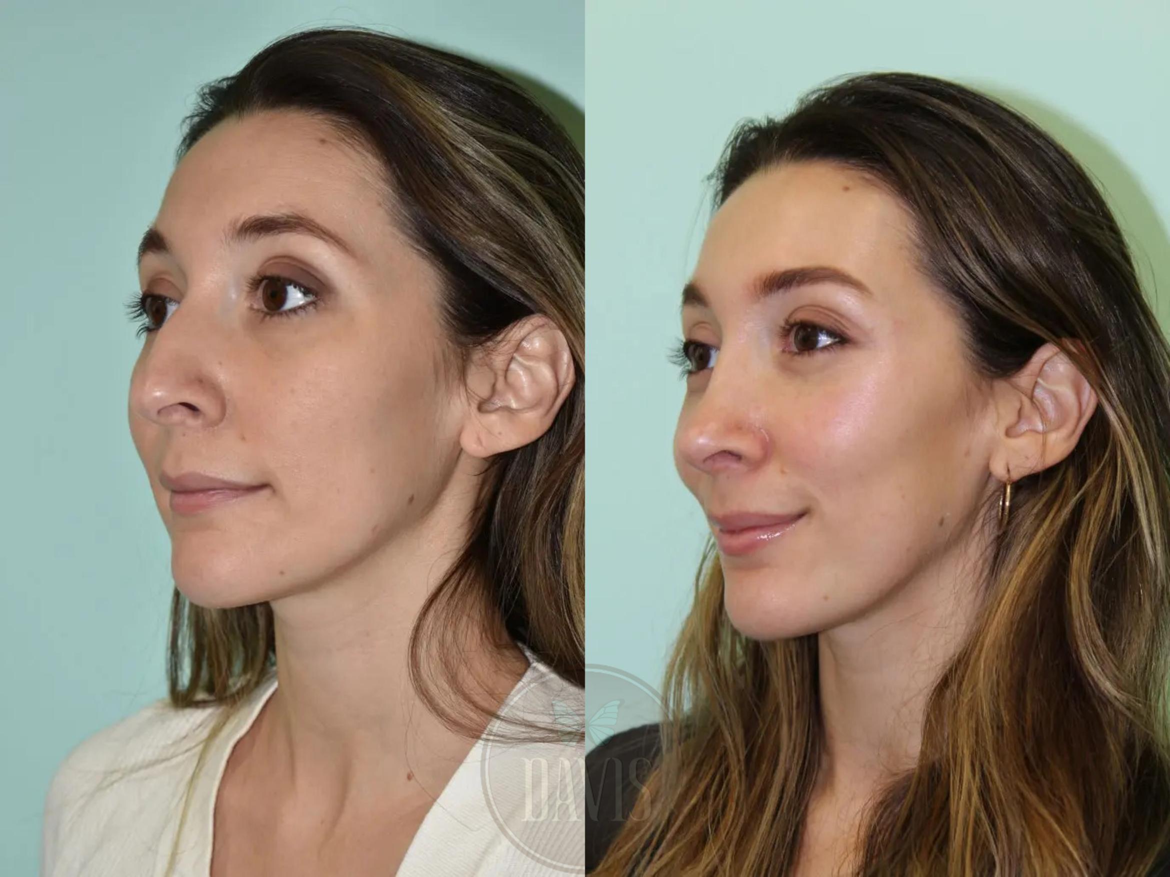 Before & After Female Rhinoplasty Case 1099 View 1 View in Tampa, FL