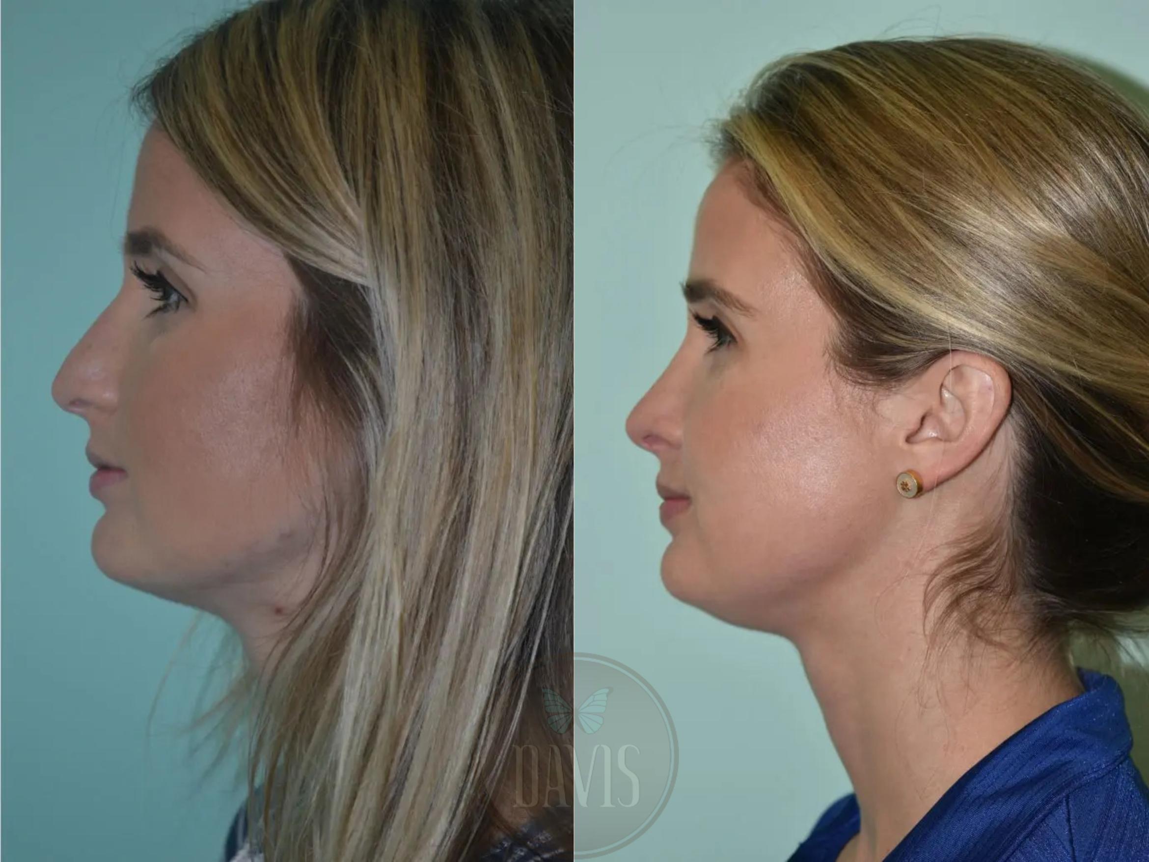 Before & After Female Rhinoplasty Case 1100 View 1 View in Tampa, FL