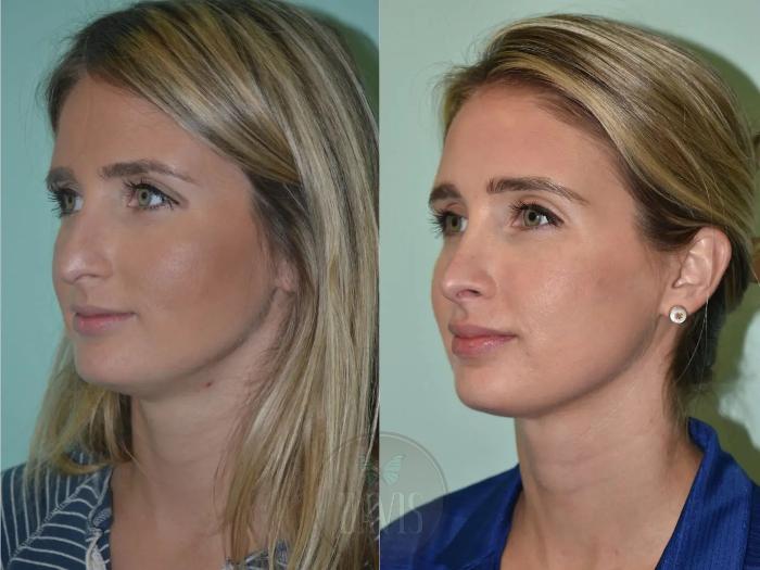 Before & After Female Rhinoplasty Case 1100 View 2 View in Tampa, FL