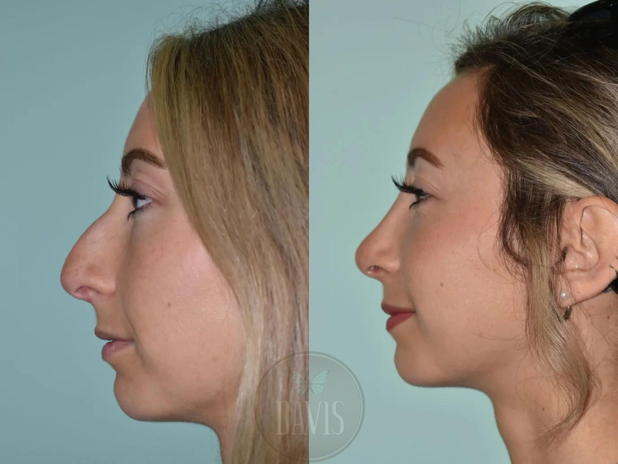 Before & After Female Rhinoplasty Case 1101 View 1 View in Tampa, FL