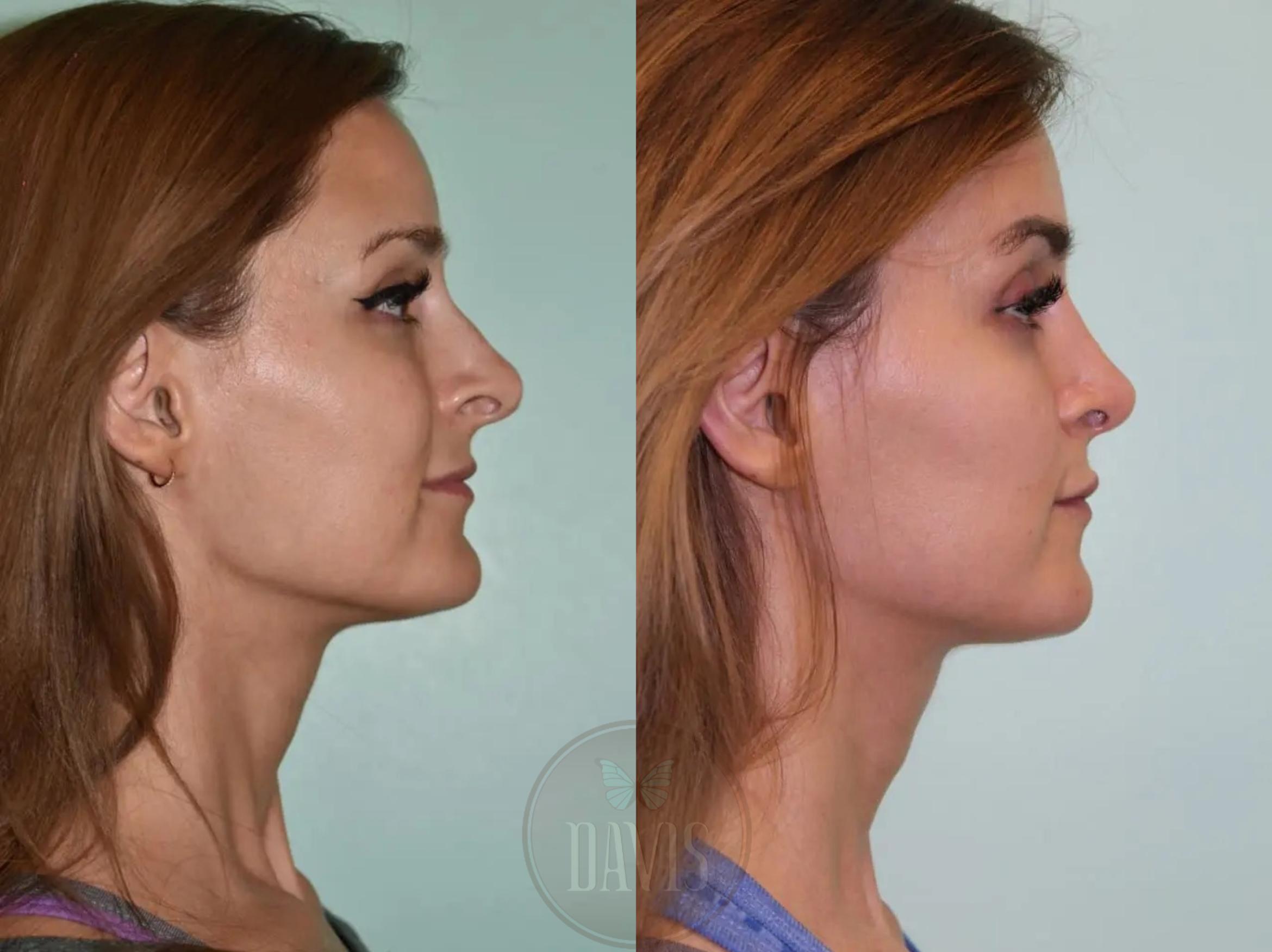 Before & After Female Rhinoplasty Case 1102 View 1 View in Tampa, FL