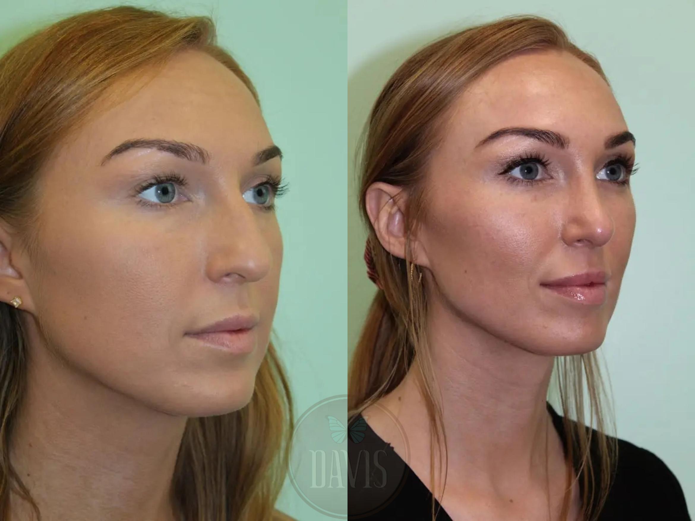 Before & After Female Rhinoplasty Case 1102 View 2 View in Tampa, FL