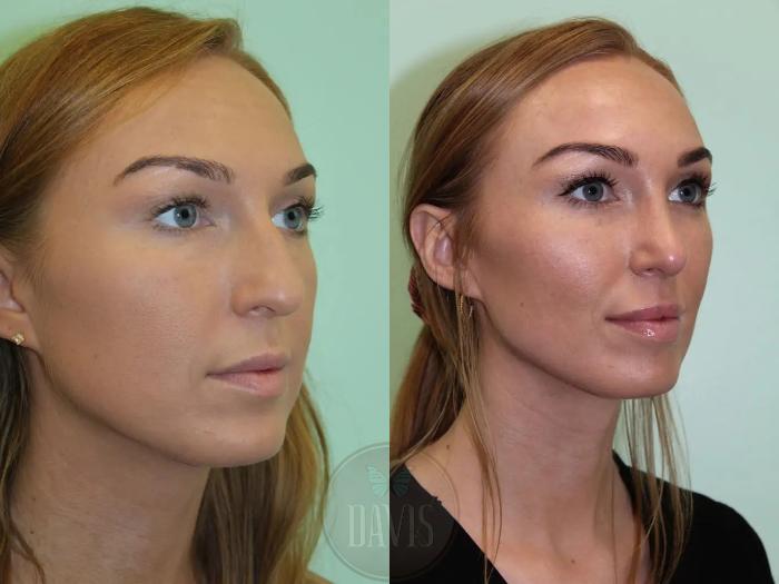 Before & After Female Rhinoplasty Case 1102 View 2 View in Tampa, FL