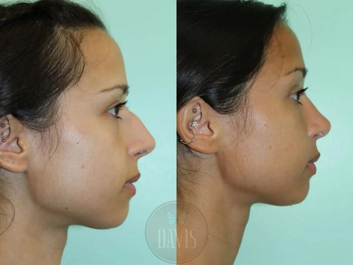Before & After Female Rhinoplasty Case 1102 View 5 View in Tampa, FL